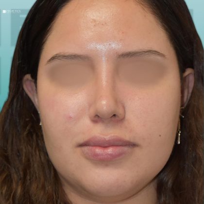 Rhinoplasty Before & After Patient #3028
