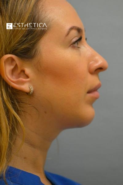 Chin Augmentation Before & After Patient #2938