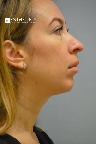 Chin Augmentation Before & After Patient #2938