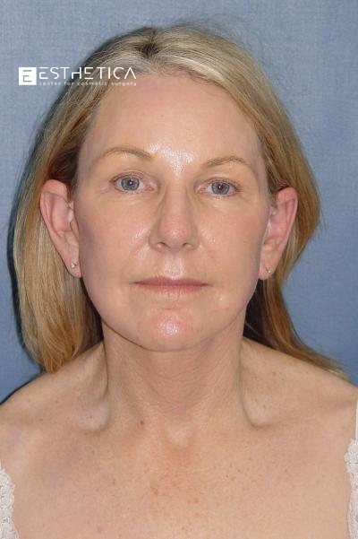 Facelift Before & After Patient #2892