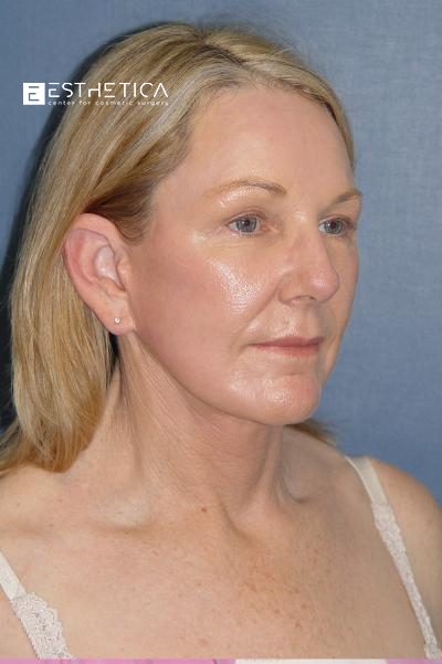 Facelift Before & After Patient #2892