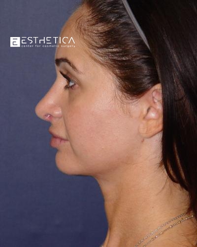 Rhinoplasty Before & After Patient #3070