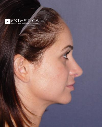Rhinoplasty Before & After Patient #3070