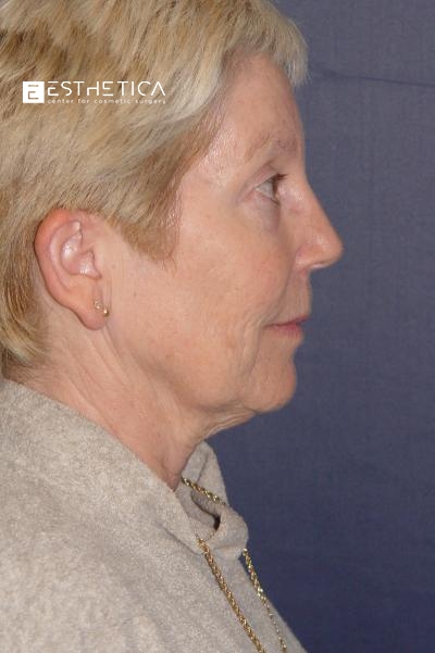 Facelift Before & After Patient #2897