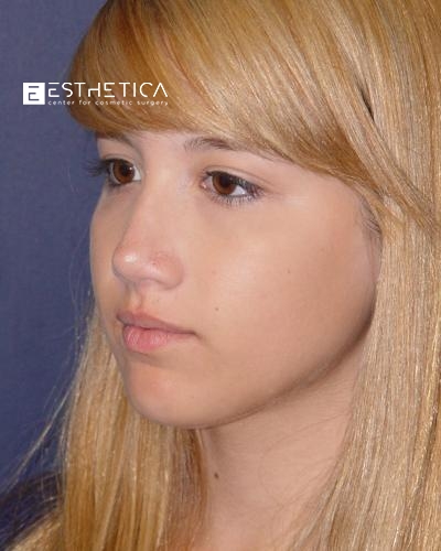 Rhinoplasty Before & After Patient #3088