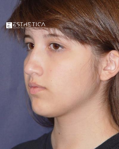 Rhinoplasty Before & After Patient #3088