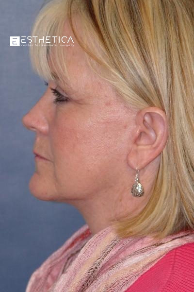Facelift Before & After Patient #2907