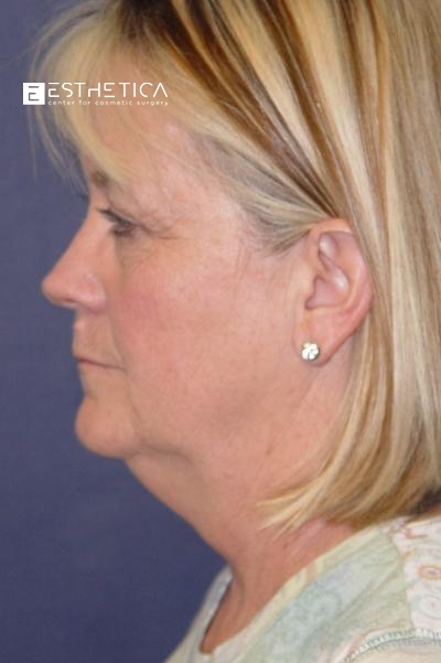 Facelift Before & After Patient #2907