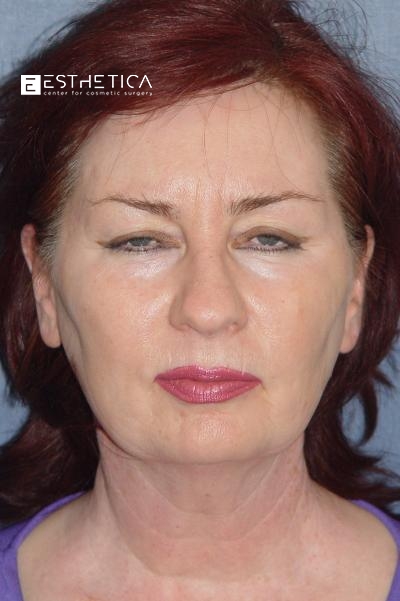 Facelift Before & After Patient #2914
