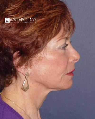 Rhinoplasty Before & After Patient #3111