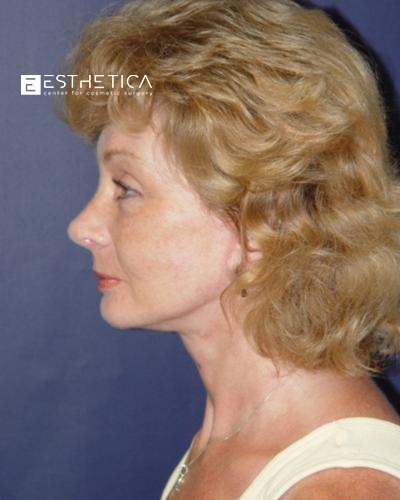 Facelift Before & After Patient #2926