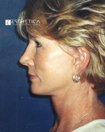 Facelift Before & After Patient #2934