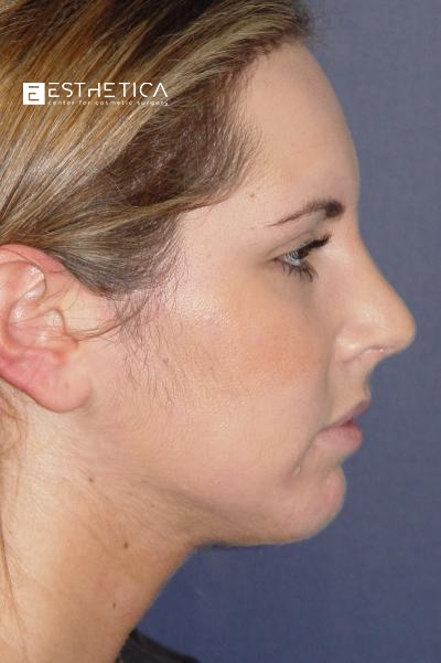 Chin Augmentation Before & After Patient #2945
