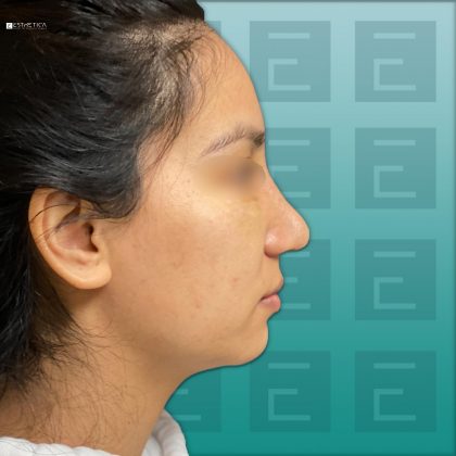 Rhinoplasty Before & After Patient #3029