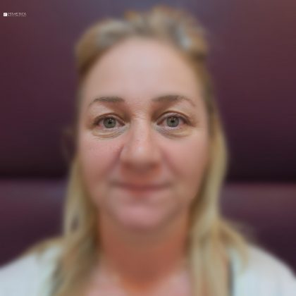 Blepharoplasty Before & After Patient #2979