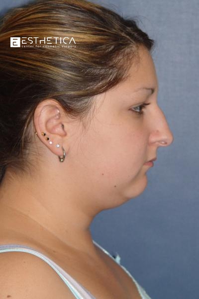 Rhinoplasty Before & After Patient #2948
