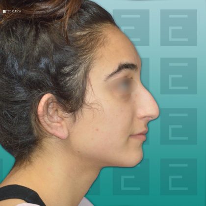 Rhinoplasty Before & After Patient #3034