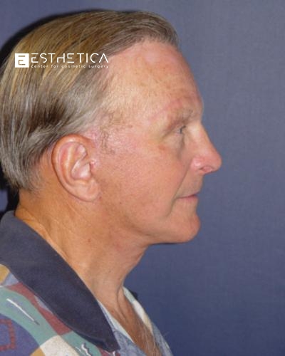Facelift Before & After Patient #2953