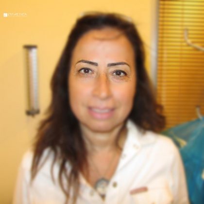 Blepharoplasty Before & After Patient #2986