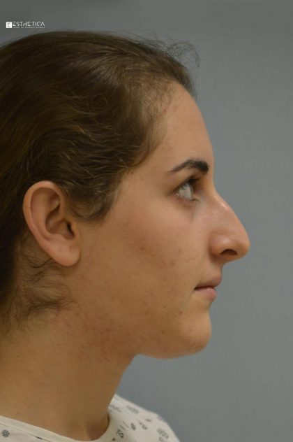 Rhinoplasty Before & After Patient #3051