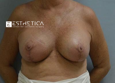 Breast Lift Before & After Patient #3449