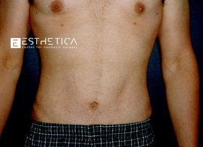 Liposuction Before & After Patient #3525