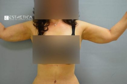 Liposuction Before & After Patient #3732
