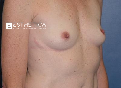 Breast Augmentation Before & After Patient #3413