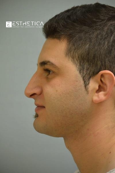 Rhinoplasty Before & After Patient #3554