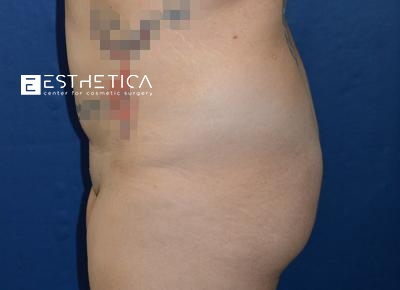 Liposuction Before & After Patient #3599