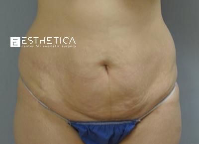 Tummy Tuck Before & After Patient #3642