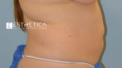 Liposuction Before & After Patient #3665