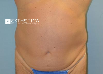 Tummy Tuck Before & After Patient #3571