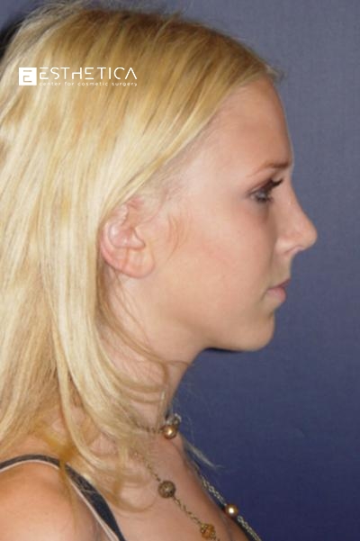 Rhinoplasty Before & After Patient #3126