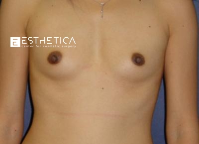 Breast Augmentation Before & After Patient #3316
