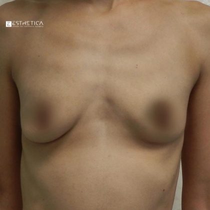 Breast Reduction Before & After Patient #3418