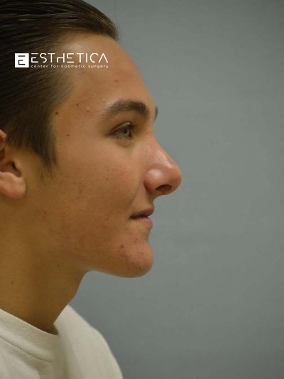 Rhinoplasty Before & After Patient #3561
