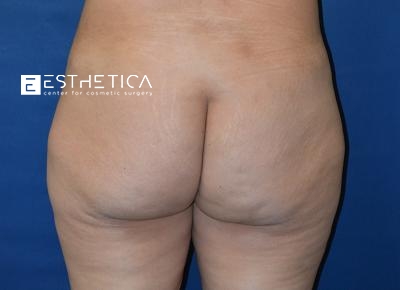 Liposuction Before & After Patient #3606