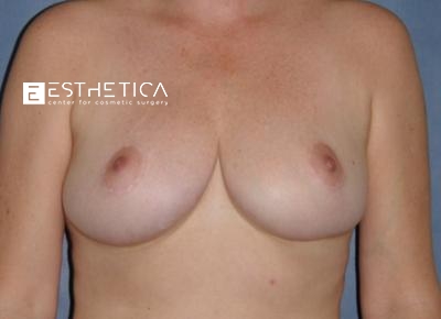 Breast Lift Before & After Patient #3465