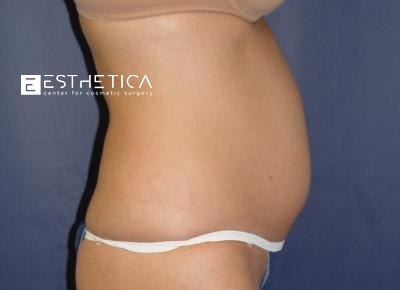Liposuction Before & After Patient #3672