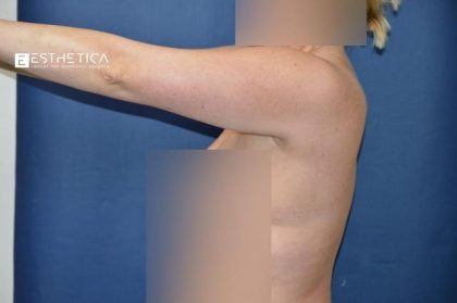 Liposuction Before & After Patient #3735