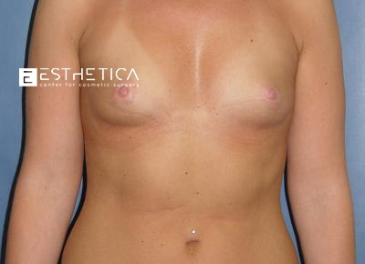 Breast Augmentation Before & After Patient #3216