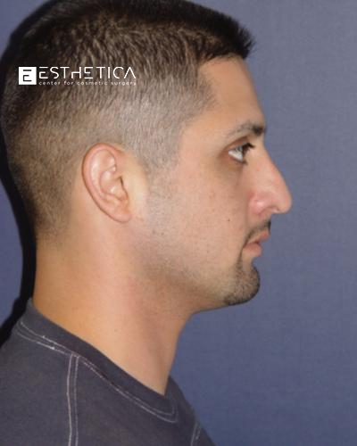 Rhinoplasty Before & After Patient #3564