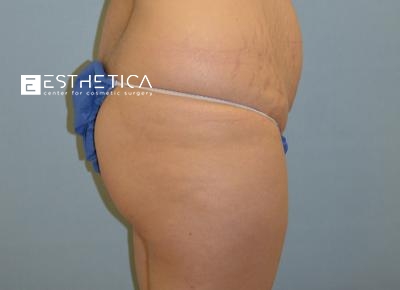 Tummy Tuck Before & After Patient #3642