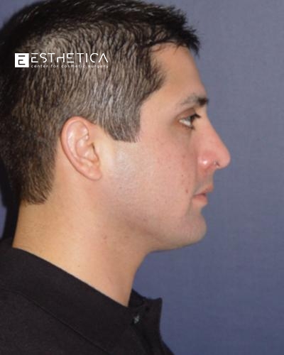 Rhinoplasty Before & After Patient #3564