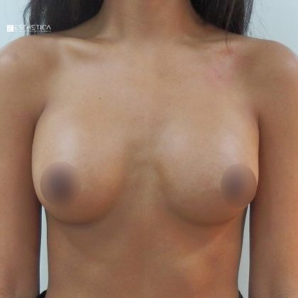 Breast Augmentation Before & After Patient #3427