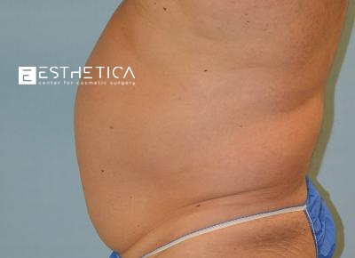 Tummy Tuck Before & After Patient #3571