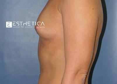 Breast Augmentation Before & After Patient #3216