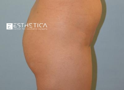 Liposuction Before & After Patient #3613