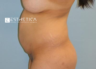 Tummy Tuck Before & After Patient #3651
